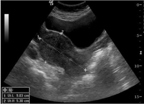 Pelvic Ultrasound
