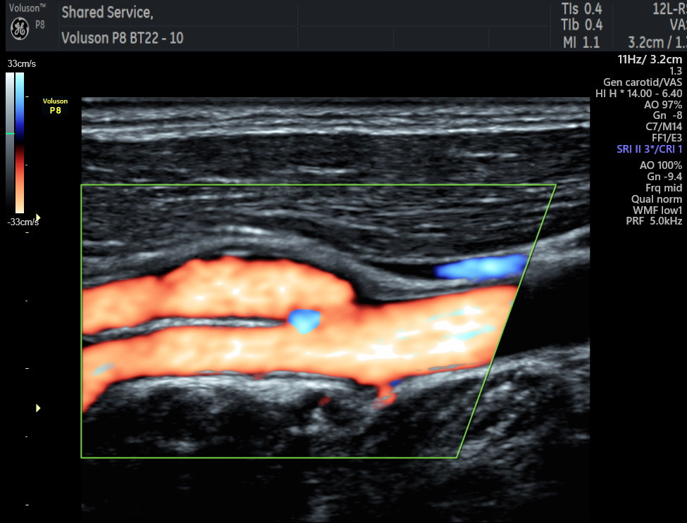 Carotid Doppler