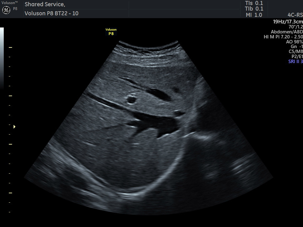Abdominal Ultrasound