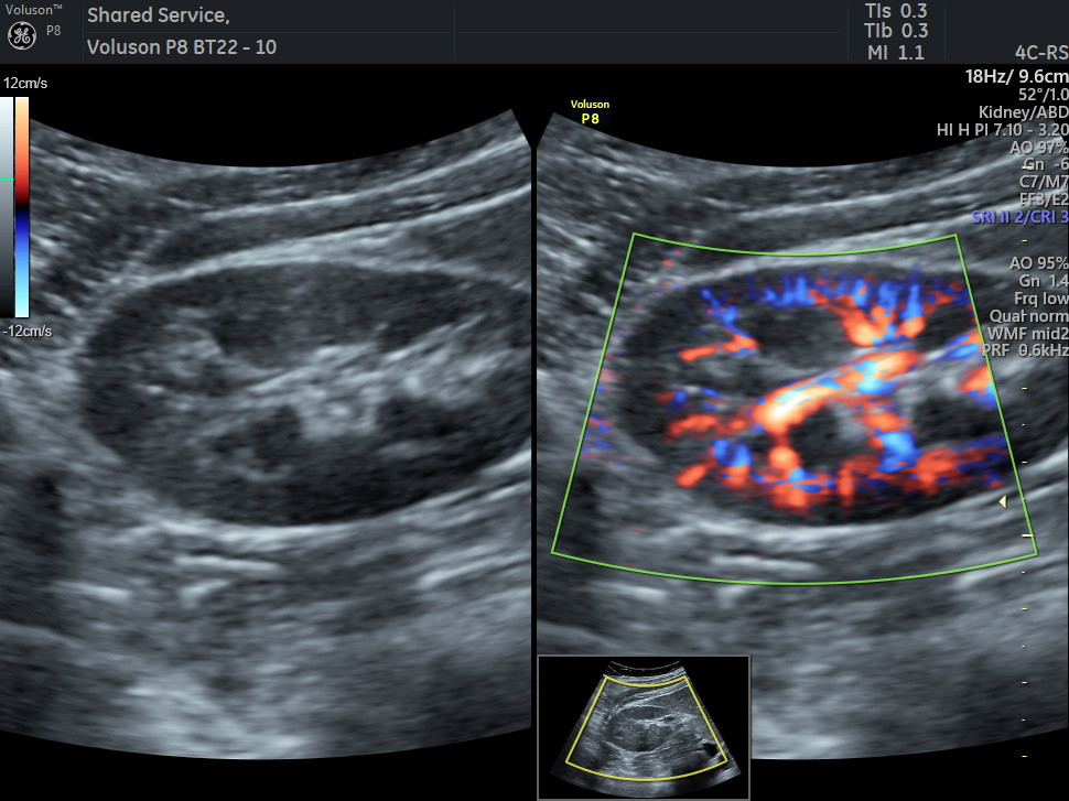 Renal Doppler
