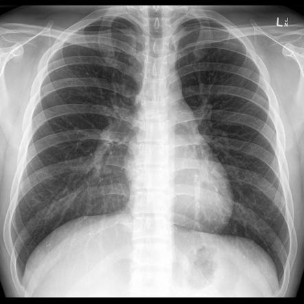 Chest X-Ray