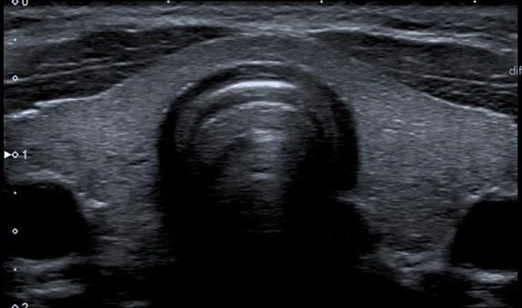 Thyroid