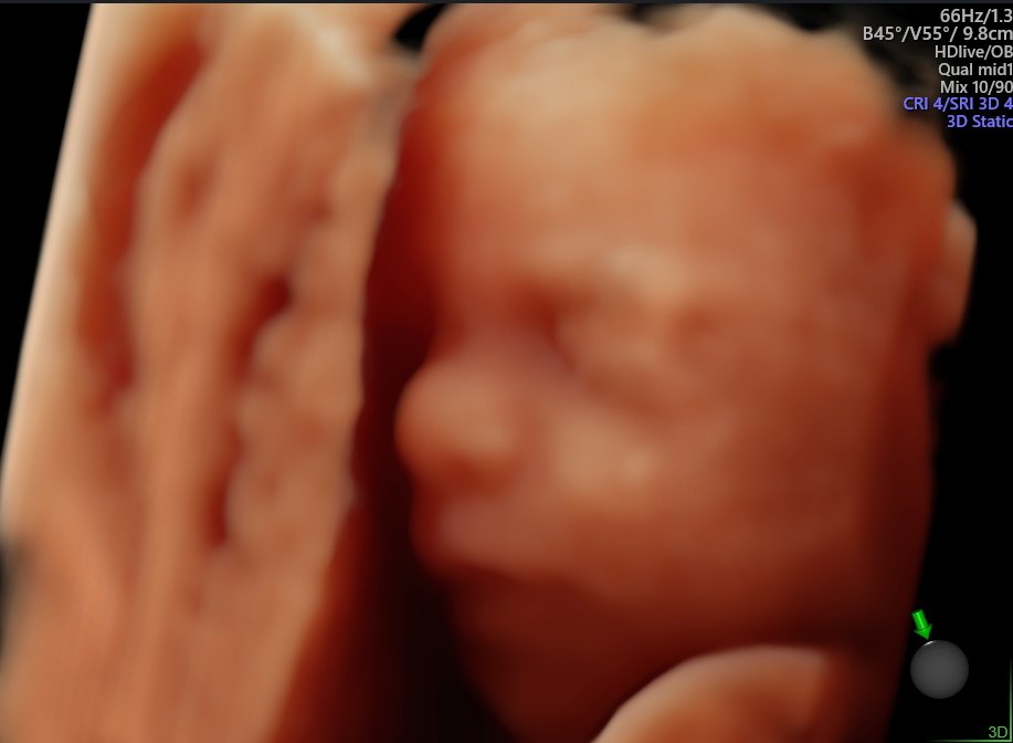 Obstetric Ultrasound