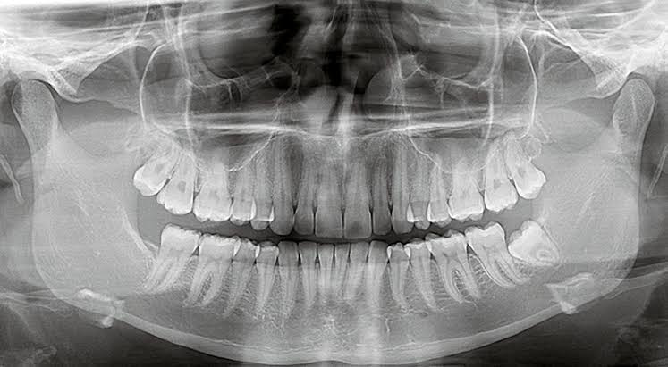 Othorpantomogram - OPG