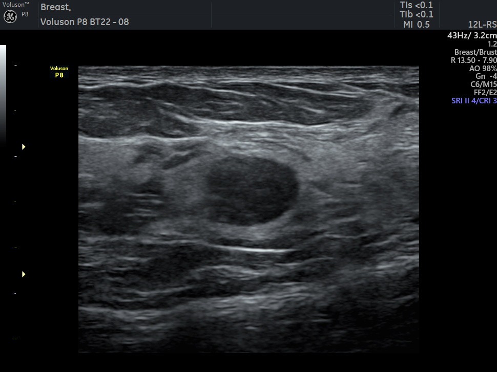 Bilateral Breast Ultrasound