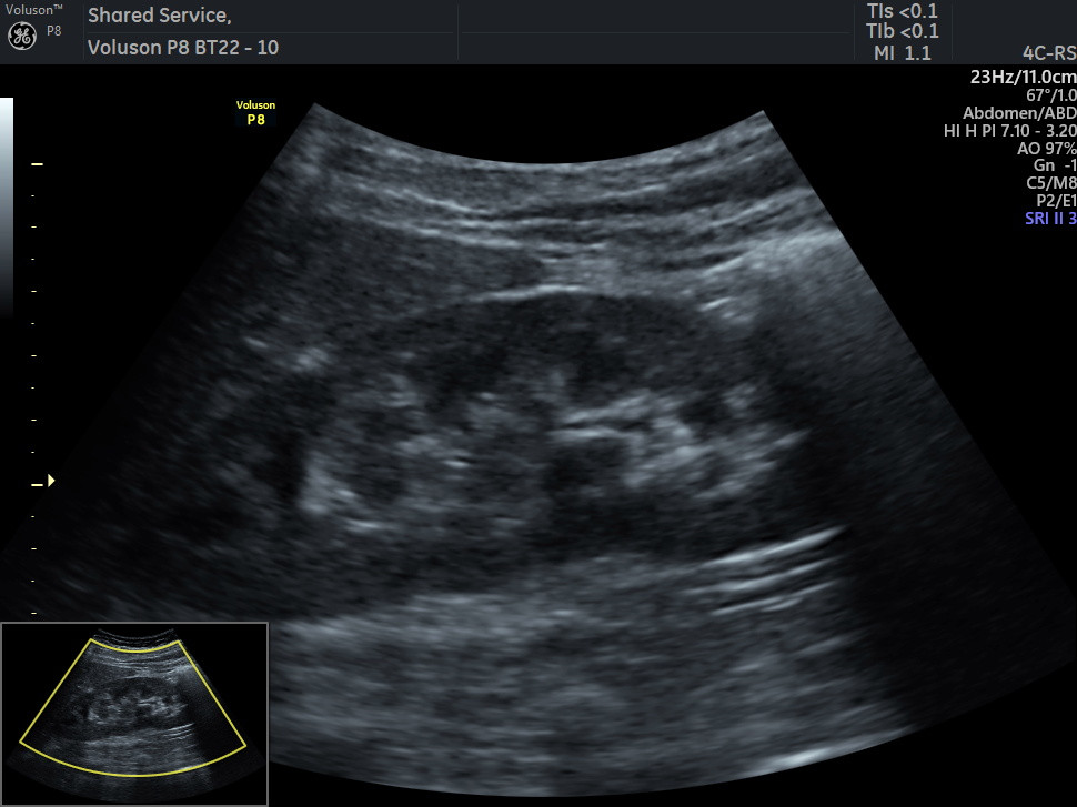 KUB Ultrasound