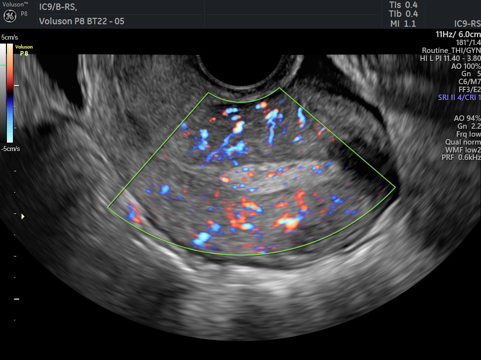 Transvaginal Ultrasound